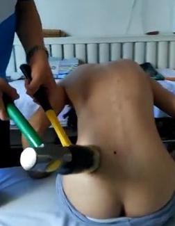 一种治疗腰突的方法,最新腰突治疗手段