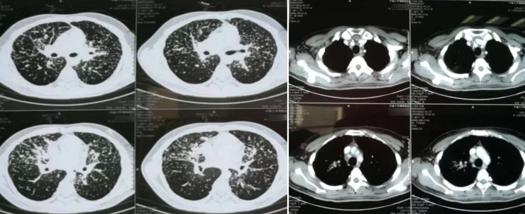 感觉身体淋巴结游走性疼痛,全身多处炎性淋巴结