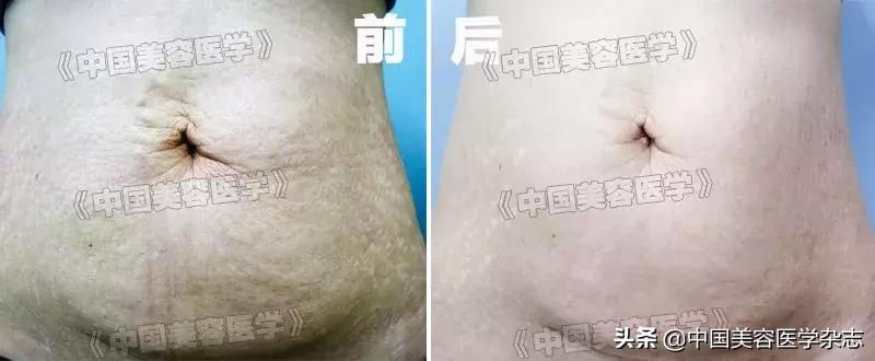 射频双极,射频综合治疗仪