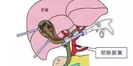 北仑人民医院腹腔镜胆囊切除术,黄浦腹腔镜胆囊切除术后症状