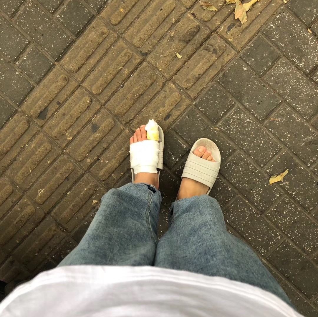 拔一根脚毛脚肿了,拔了脚趾甲后整个脚肿了怎么回事