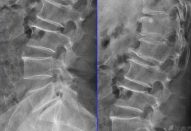 骨质增生和骨关节炎补钙有用吗,骨刺骨质增生关节炎用什么药