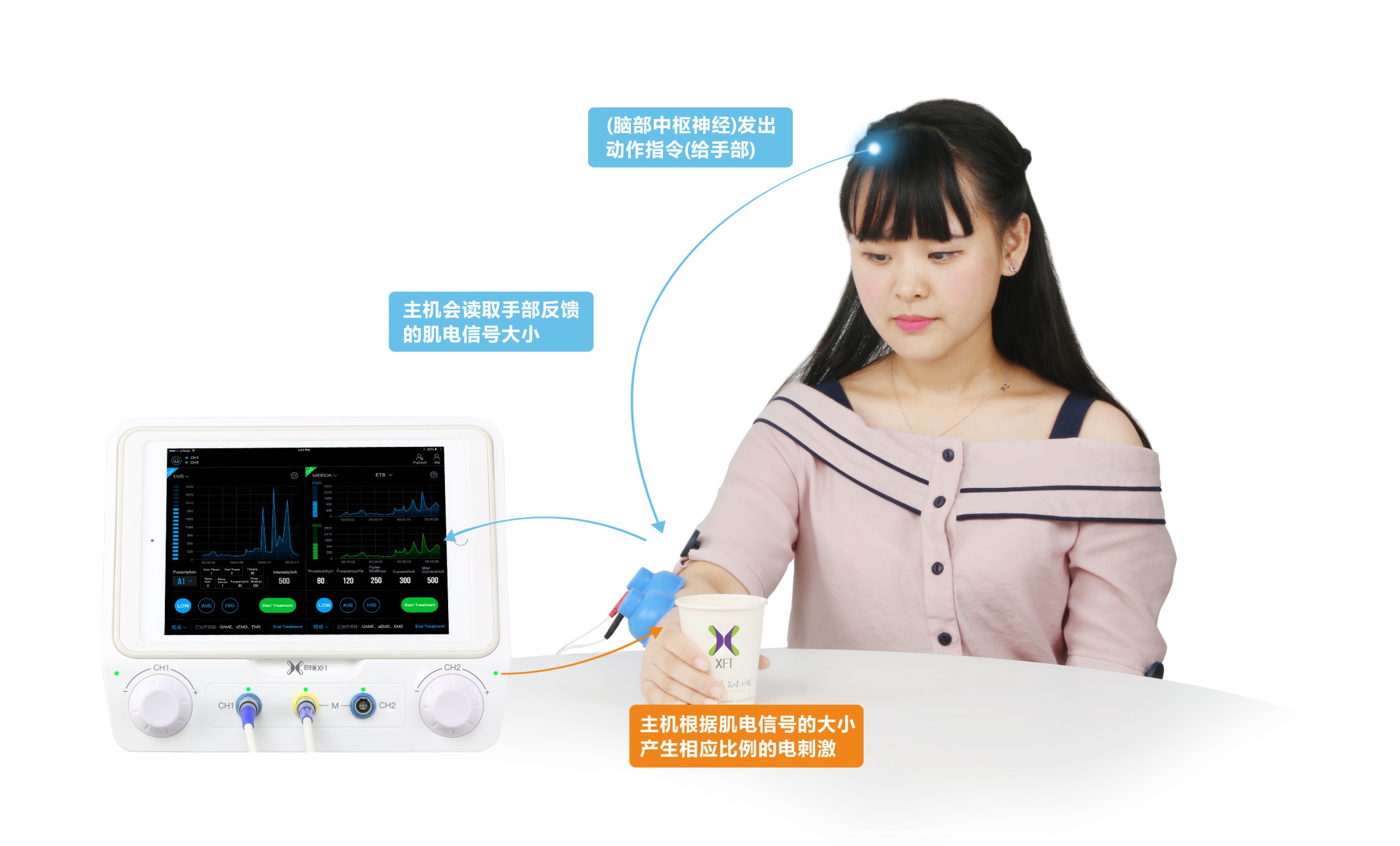 FES在脑卒中康复治疗中的应用分析