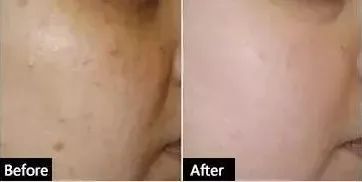 果酸可以根治闭口吗,果酸去闭口可以天天用吗