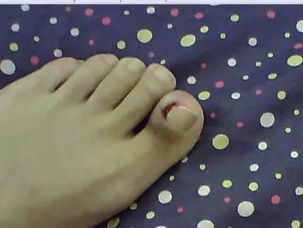 摆脱甲沟炎的痛苦之后的感想,甲沟炎的亲身经历