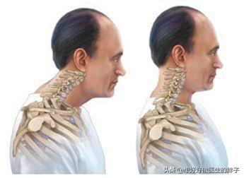 颈椎病和肥胖有关系么,脖子后面有堆肉是颈椎出问题了吗