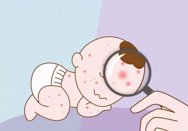 怎么护理宝宝脸上的湿疹,湿疹宝宝皮肤如何护理