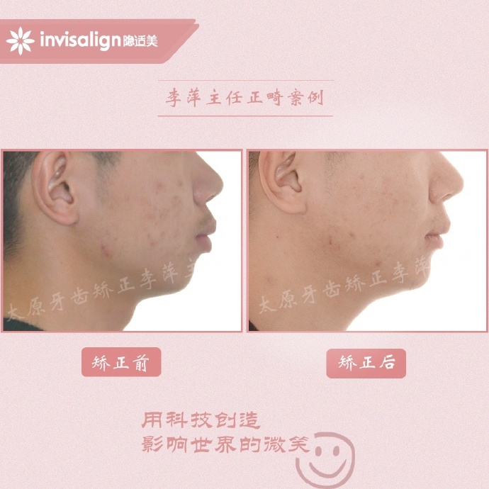 重度牙齿拥挤矫正经历,太原矫正牙齿需要多久