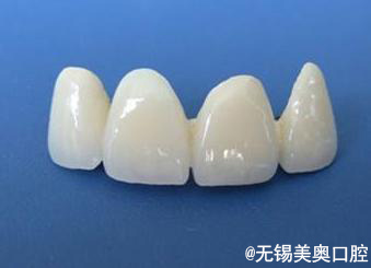 烤瓷牙和全瓷牙应该怎么选,全瓷牙和烤瓷牙会有口臭吗