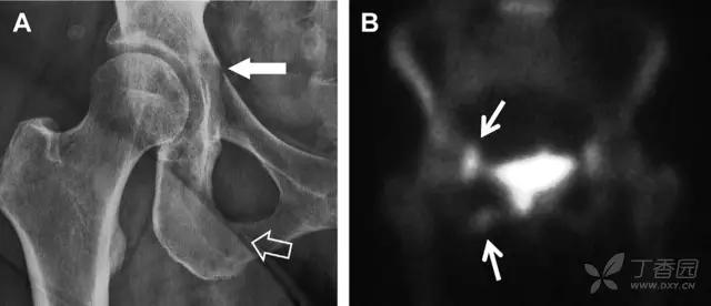 放射科夜班病例大全,放射科容易漏诊的骨折