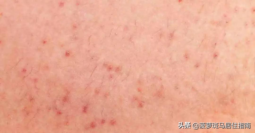 脱毛方法大盘点,脱毛攻略不要广告