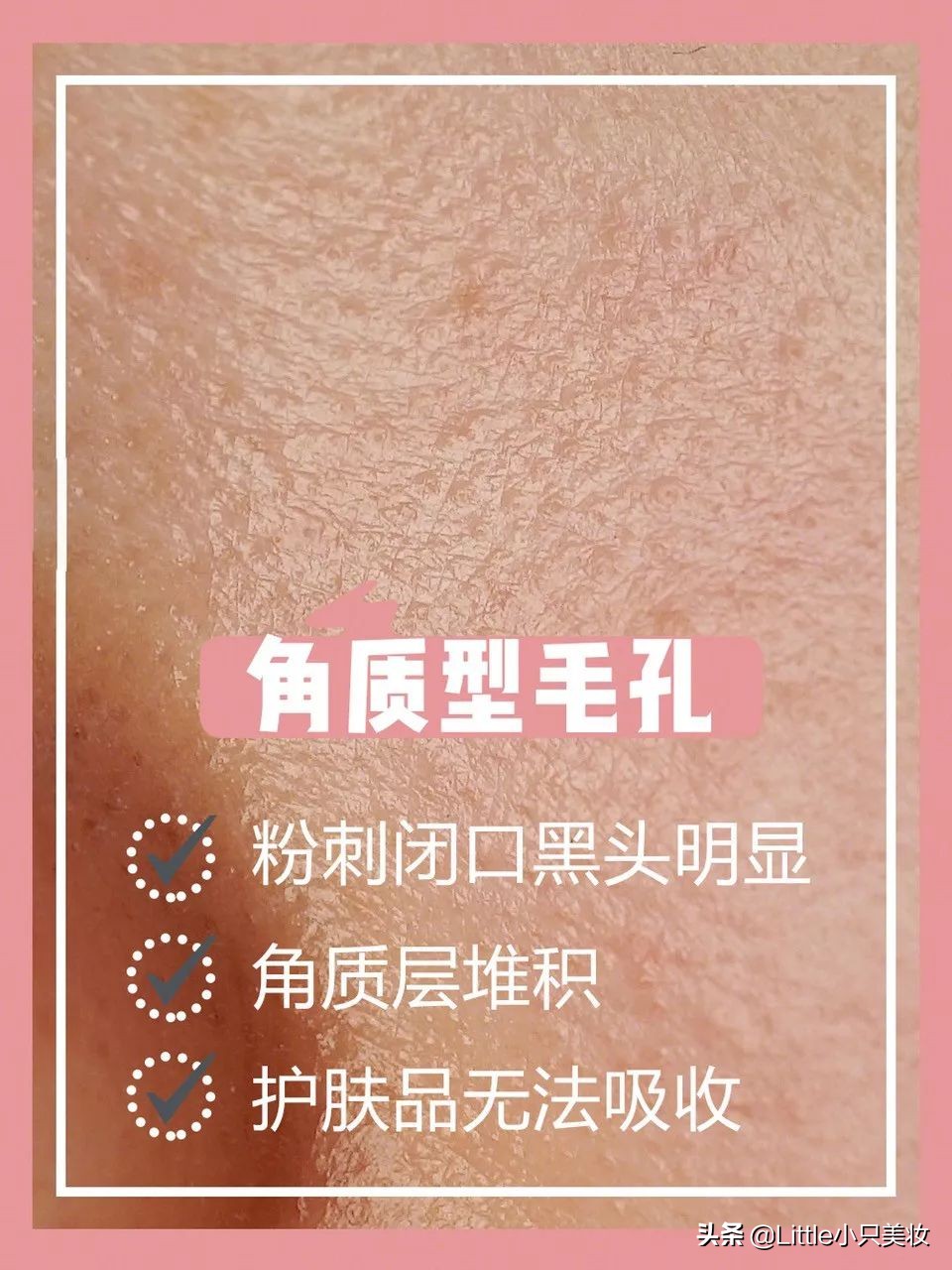 简单几招让你迅速解决粗大毛孔,改善毛孔粗大最有效的办法测评