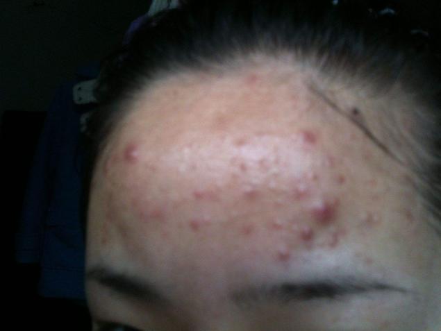 脸上疯狂长痘痘无药可救？教你5个技巧，从此告别问题肌肤