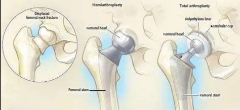老人摔伤股骨头骨折咋办,老年人摔倒致股骨颈骨折如何处理