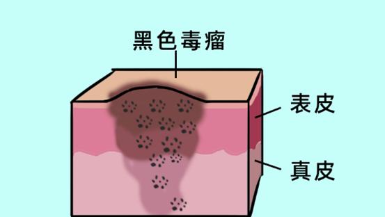科普一颗平淡无奇的痣竟然会癌变,痣癌变的信号有哪些