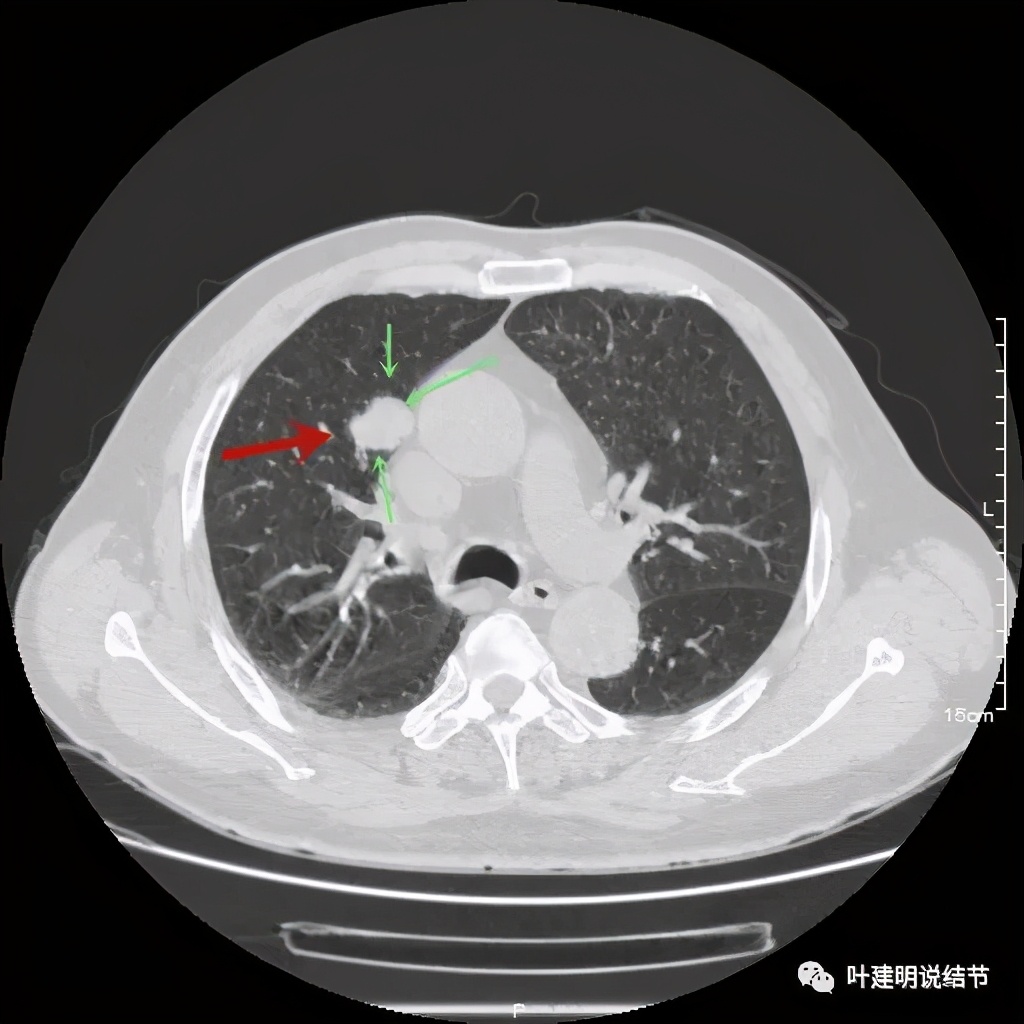 误诊报告图片,误诊案例及案例分析