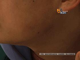 打完瘦脸针成了蛙脸怎么办,打完瘦脸针出现蛙腮会消失吗