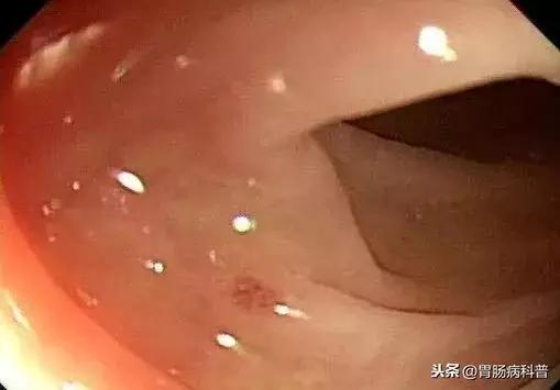 我做普通肠镜的经历及感受,年轻人做普通肠镜可以忍受吗