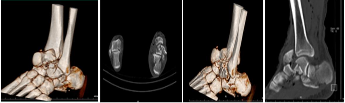 踝关节扭伤恢复训练,踝关节扭伤微创手术多久恢复