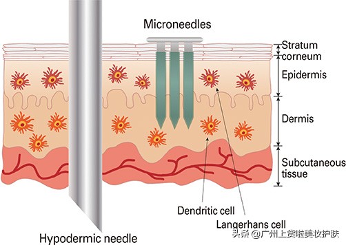 现在流行的美容打什么针,美容上的微针是怎么回事