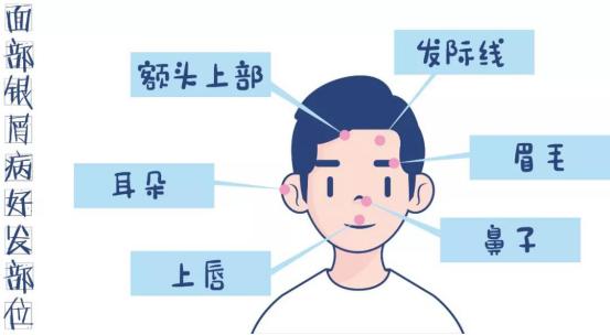 分享治疗牛皮癣方法,分享皮肤该怎么弄