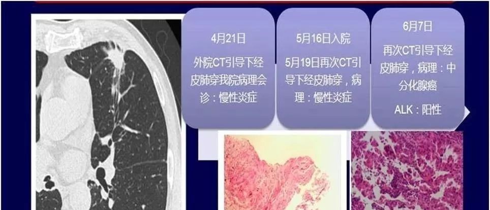 肺小结节的诊断,肺小结节的最佳治疗方法是什么