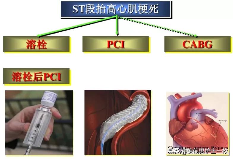 急性心梗的紧急处理视频,一旦发现急性心梗如何救