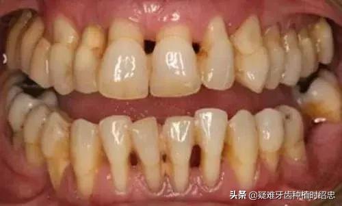 牙周炎牙齿松动要拔掉吗,牙周炎引起牙齿松动严重需要拔吗