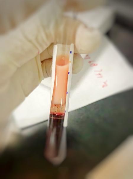 去医院抽血了但是没报告,医院查血一管到底抽了多少