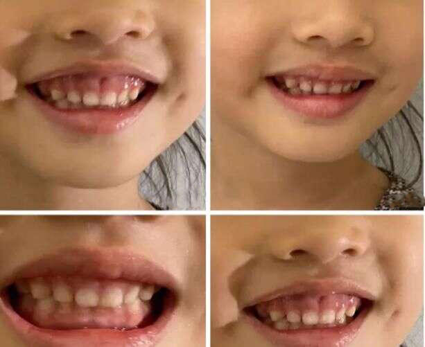 大笑时不自觉露出牙龈能否矫正,一笑牙龈就露出来了可以矫正吗