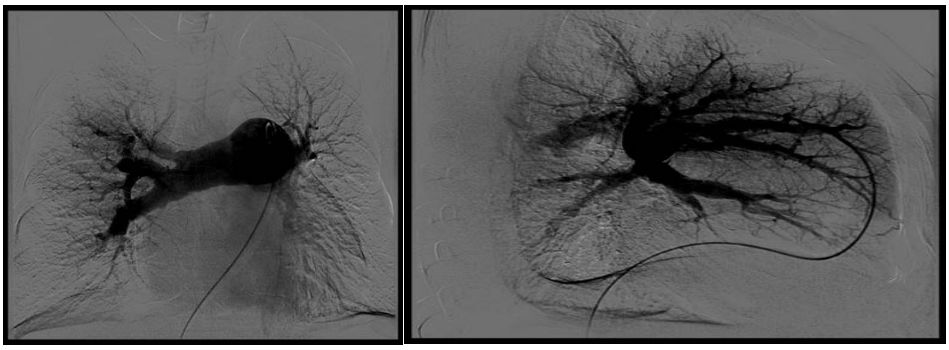 肺动脉血栓栓塞引起的肺高压,慢性血栓性肺动脉高压吃什么中药