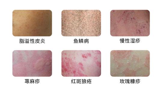 贵州银屑病医保,医院精准扶贫实施方案