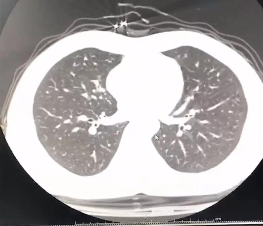 感染新冠病毒自我隔离需要做什么,新冠病毒隔离到底是14天还是21天