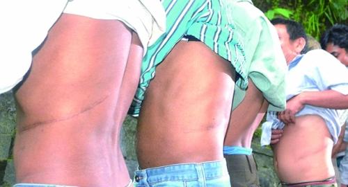 尼泊尔“卖肾村”：穷人700美元卖一个肾，人人身上一道疤