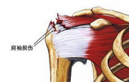 肩峰撞击综合征运动疗法,肩峰撞击综合症的锻炼