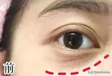 眼角皱纹最显老要注意防晒,眼角皱纹去皱最有效的方法