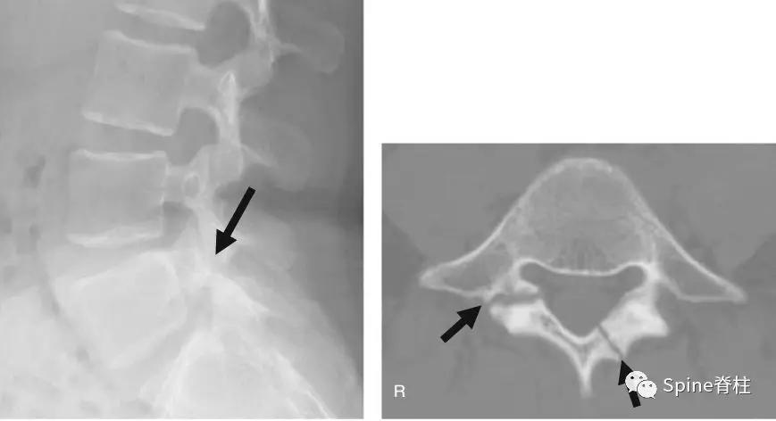 青少年一跑步就腰痛,青少年腰痛是什么原因引起的