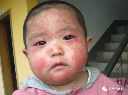 宝宝出现湿疹的原因和护理措施,高烧湿疹的症状及治疗方法