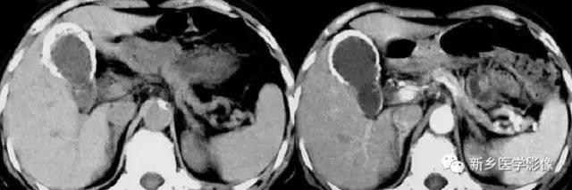 腹部平片能看到结石吗,腹部高密度结节影是什么
