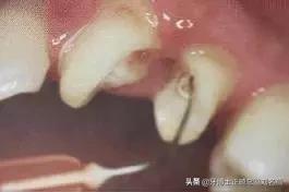 纤维桩修复费用,纤维桩修复全过程视频