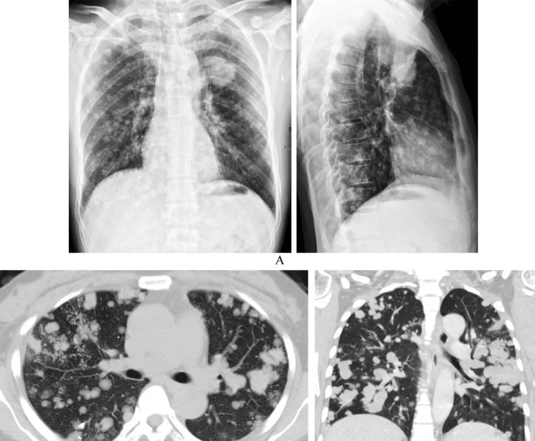 甲状腺癌转移到淋巴和肺能活多久,甲状腺癌转移肺最佳治疗方法