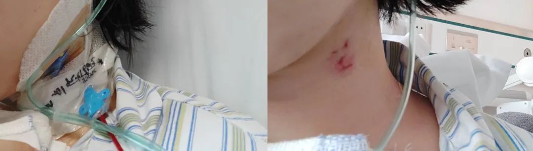 做完锥切和普通人一样吗,开胸手术的患者自述