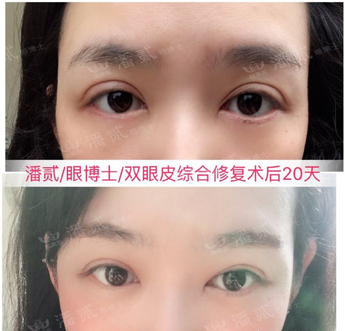 10个工作室做，9个毁，祛眼袋连卧蚕也没了，直接送我到10年后