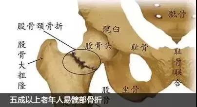 老年人跌倒后髋部疼痛是什么骨折,老人髋部骨折不治后果严重吗