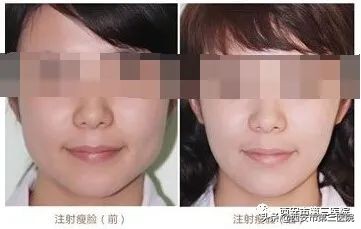 肉毒素能美白皮肤吗,肉毒素在医学美容的作用