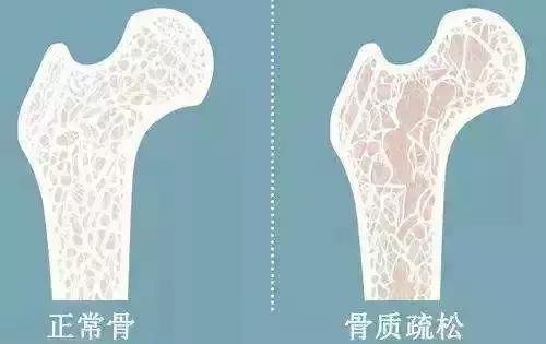 老年人骨质疏松腰椎压缩性骨折,老年骨质疏松腰椎骨折怎样康复