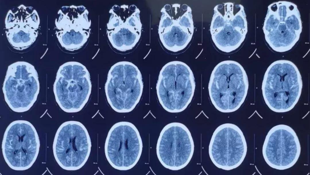 突然头疼要炸了怎么回事,睡觉突然头疼剧烈要炸了