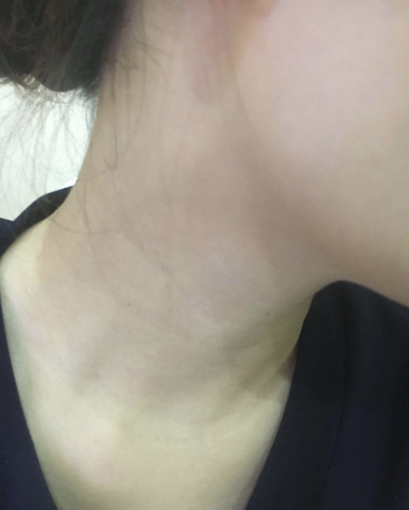 脖子上的颈纹怎么锻炼才能淡化,去脖子颈纹最好的方法真实有效