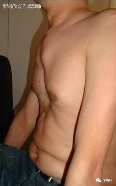 马凡综合征特殊面容,马凡综合征完整