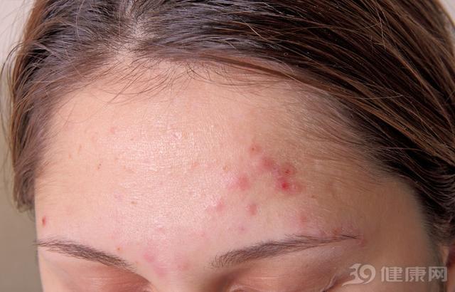 脸上的螨虫洞会愈合么,脸上螨虫挤出来有个洞用什么药膏